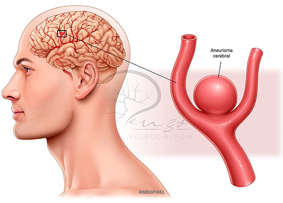 Aneurisma cerebral ilustração