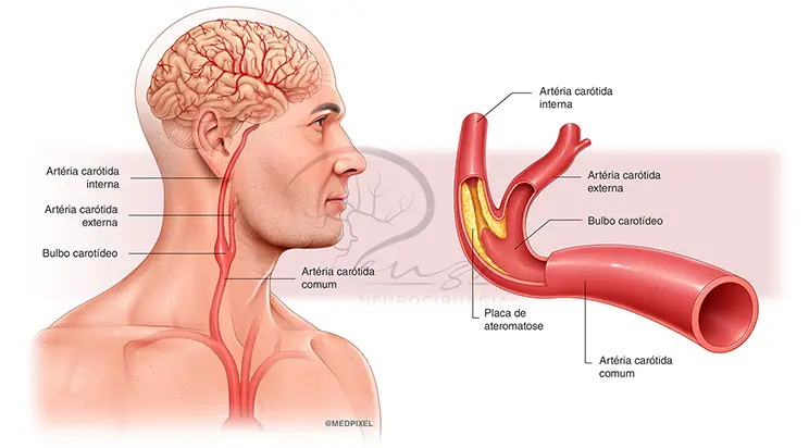 Ateromatose carótida