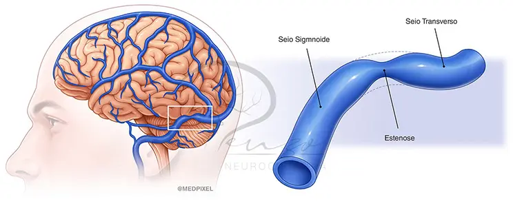 img-hipertensao-tratamento Ilustração estenose